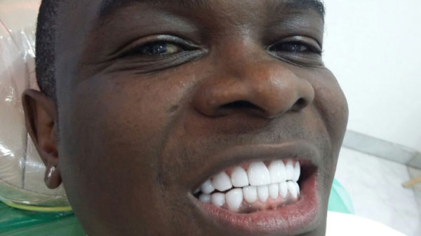 Jack Pemba new teeth