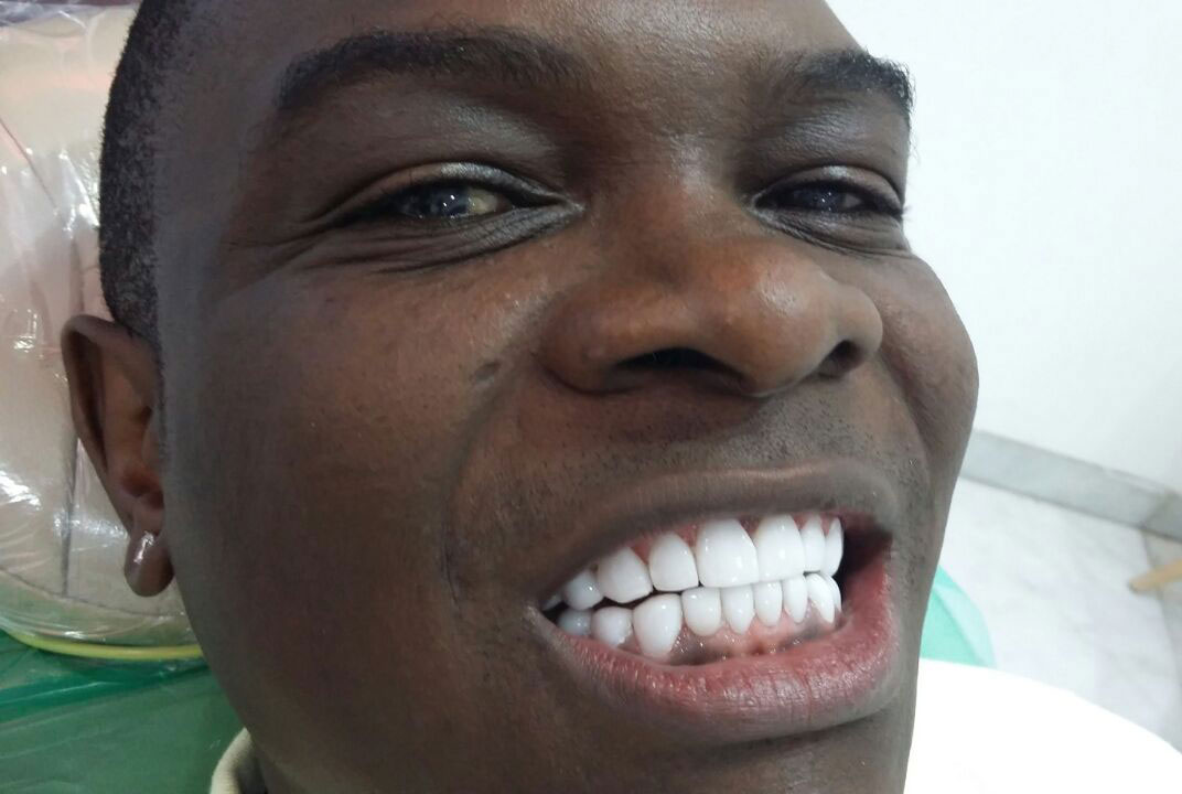 Jack Pemba new teeth